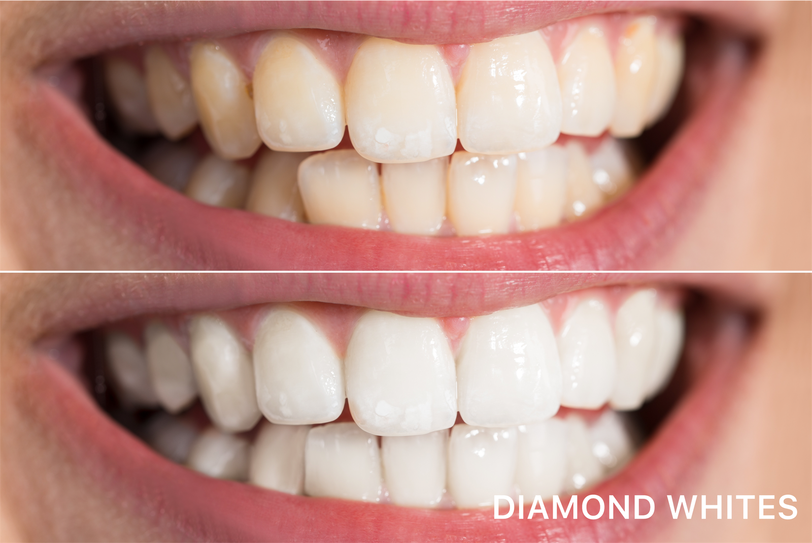 PAP+ Whitening Kit